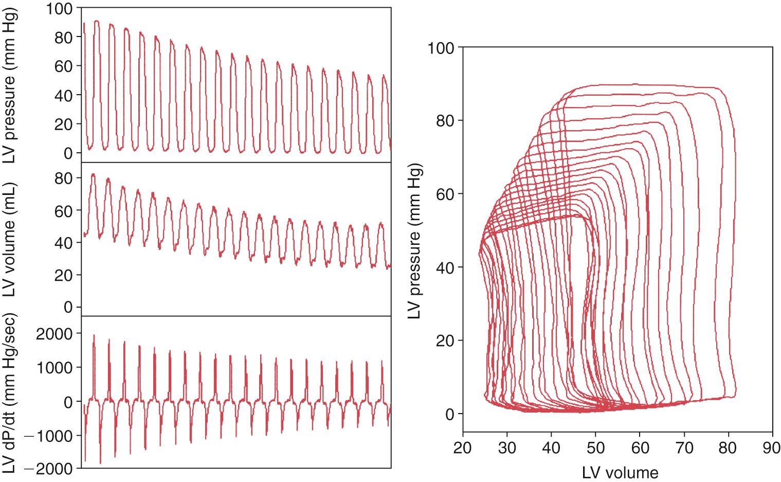 Fig. 65.3, Left, Changes in left ventricular (LV) pressure, volume, and rate of change of pressure (dP/dt) recorded with a conductance catheter during caval occlusion. Right, Series of pressure-volume loops is generated, with a linear relationship between pressure and volume at end-systole.