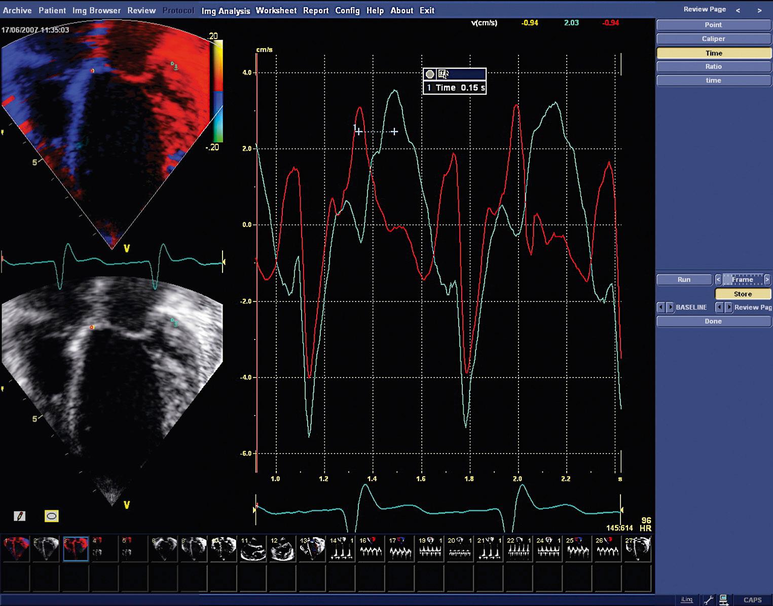 Fig. 65.4, Dyssynchrony of left ventricular function, demonstrated with tissue Doppler imaging. The time to the peak of inward movement of the lateral part of the annulus occurs 150 ms after the peak inward movement of the central fibrous body.