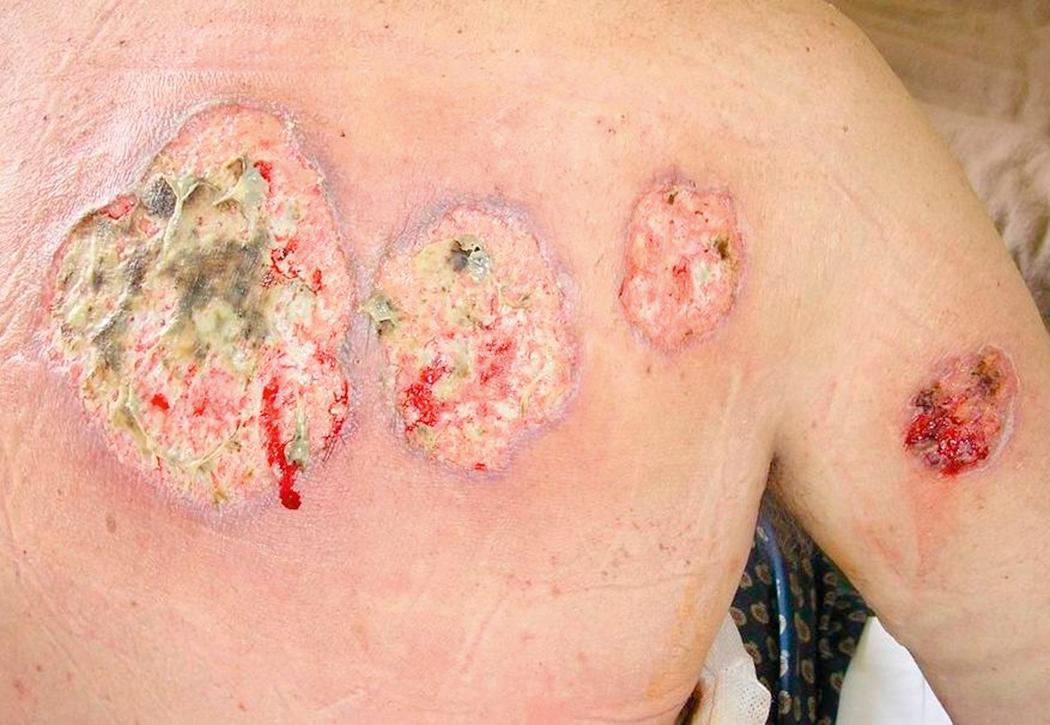 Fig. 3.11, Pyoderma gangrenosum can occur in the upper arm and posterior chest wall.