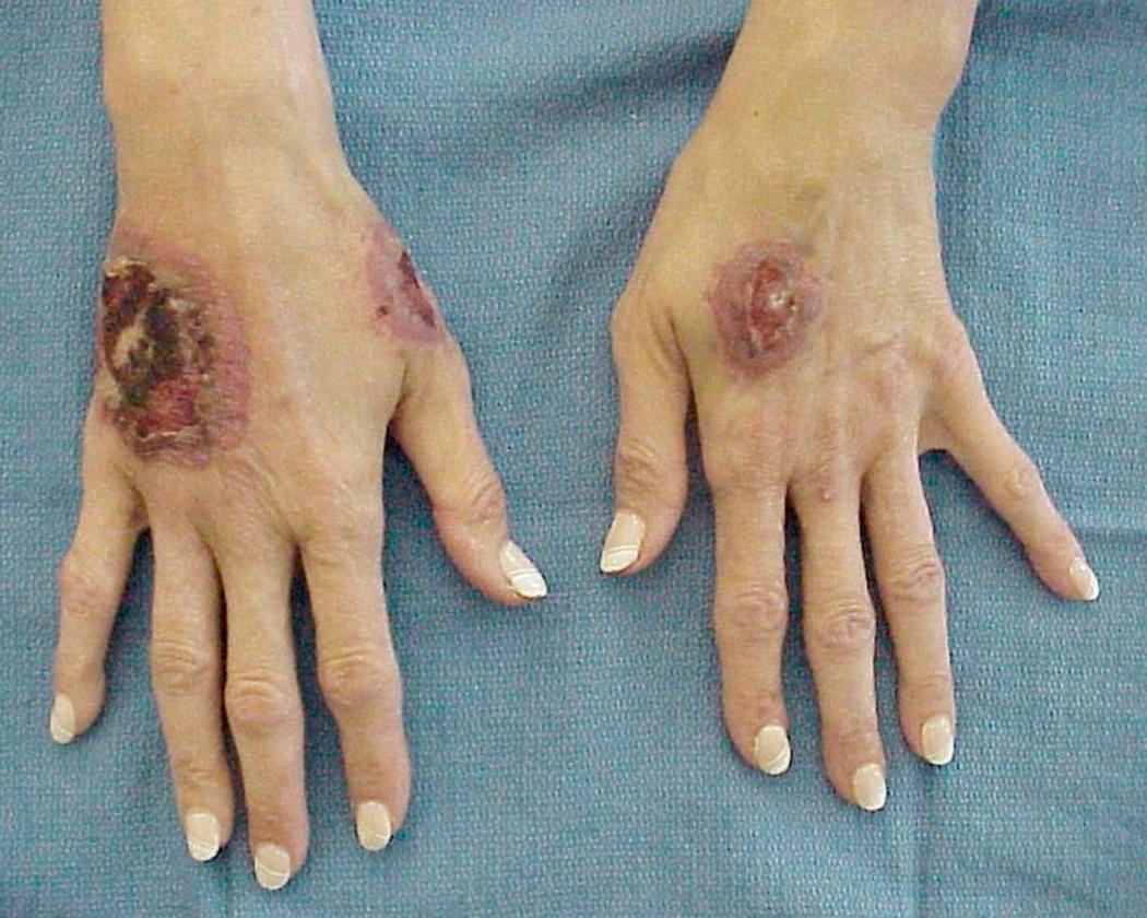 Fig. 3.12, Neutrophilic dermatoses of the dorsal is characterized by pyogenic granuloma-like lesions on the dorsal side of both hands.