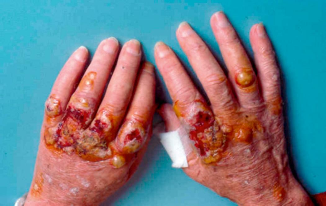 Fig. 3.13, Neutrophilic dermatoses of dorsal hands may extend into the fingers.