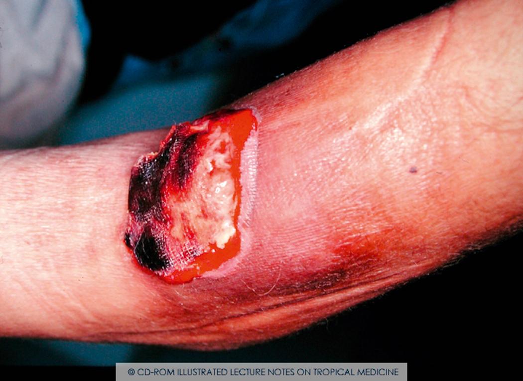 Fig. 3.2, Bacillary angiomatosis can present as a large ulcer with necrotic areas in an AIDS patient.