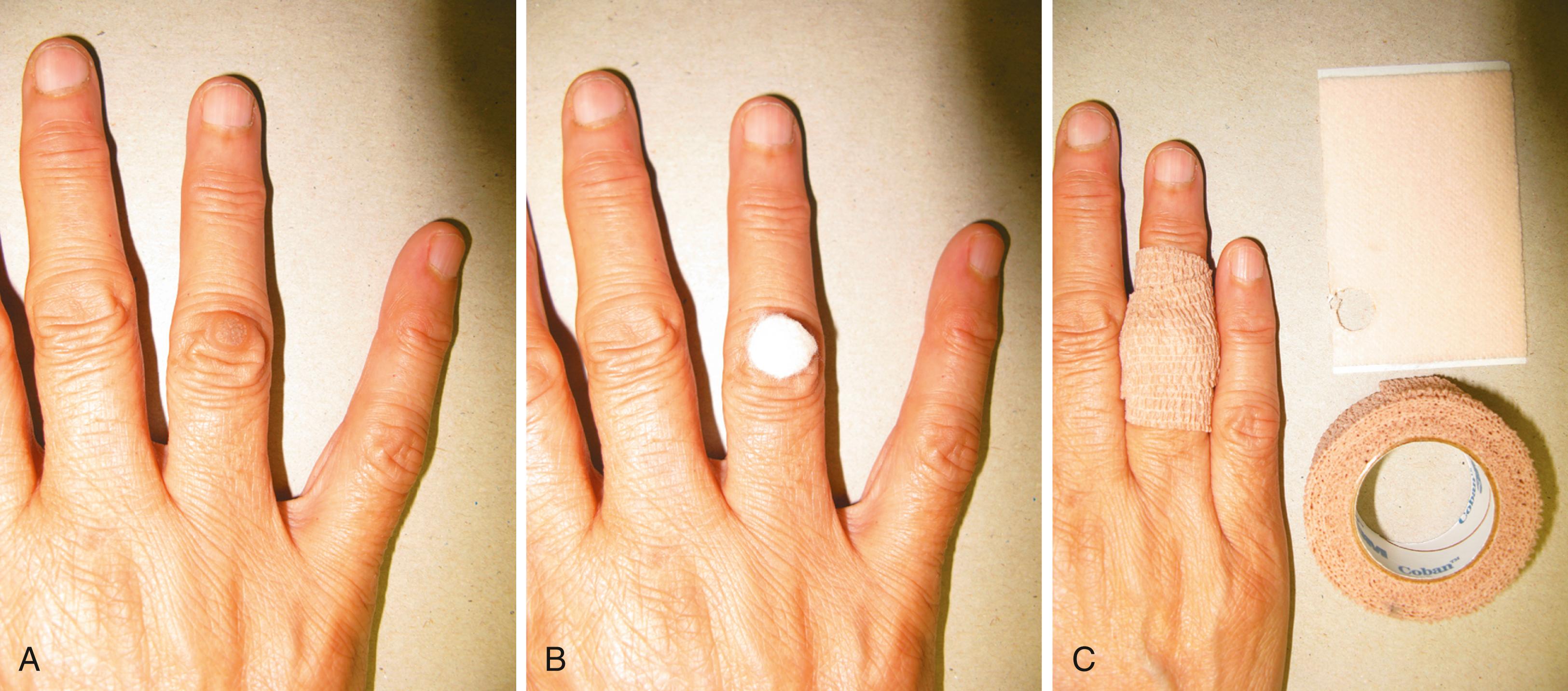 Fig. 3.3, A, Typical wart in the hand of a woman who frequently immerses her hands in water. B, A piece of medicated adhesive tape (Mediplast) slightly larger than the diameter of the wart is applied over the lesion. C, The tape is secured in place with waterproof tape (Coban).