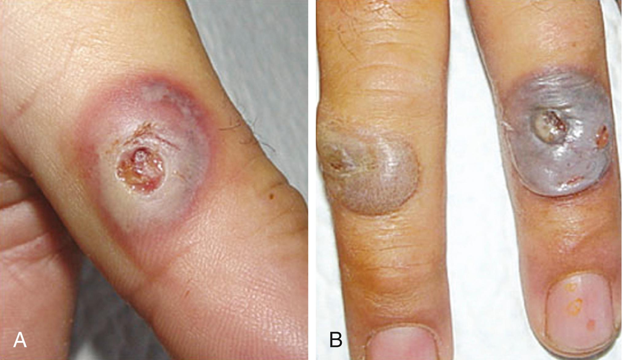 Fig. 3.4, Orf can infect one or two fingers simultaneously. A, The lesion has an umbilicated red center, a white middle, and a peripheral violaceous halo. B, The lesion may be bulbous and affect multiple fingers.