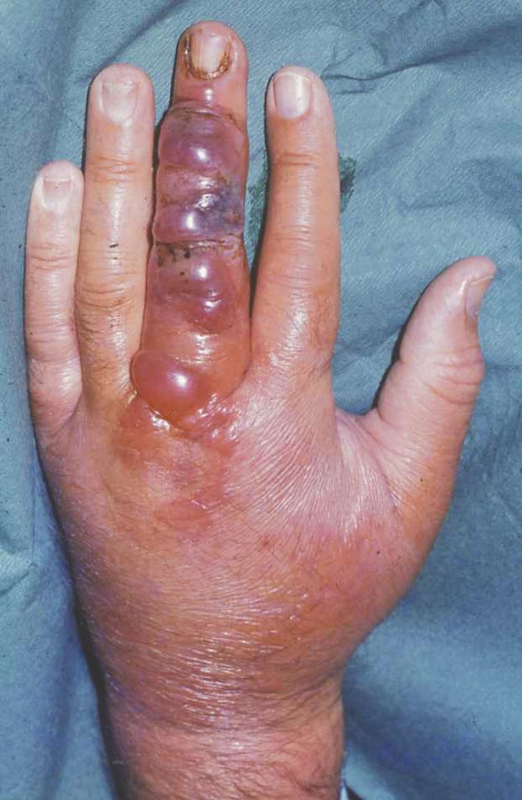 Fig. 3.5, The initial lesion of cutaneous anthrax is a vesicle or vesicles surrounded by erythema. The vesicle contains clear or bluish fluid.