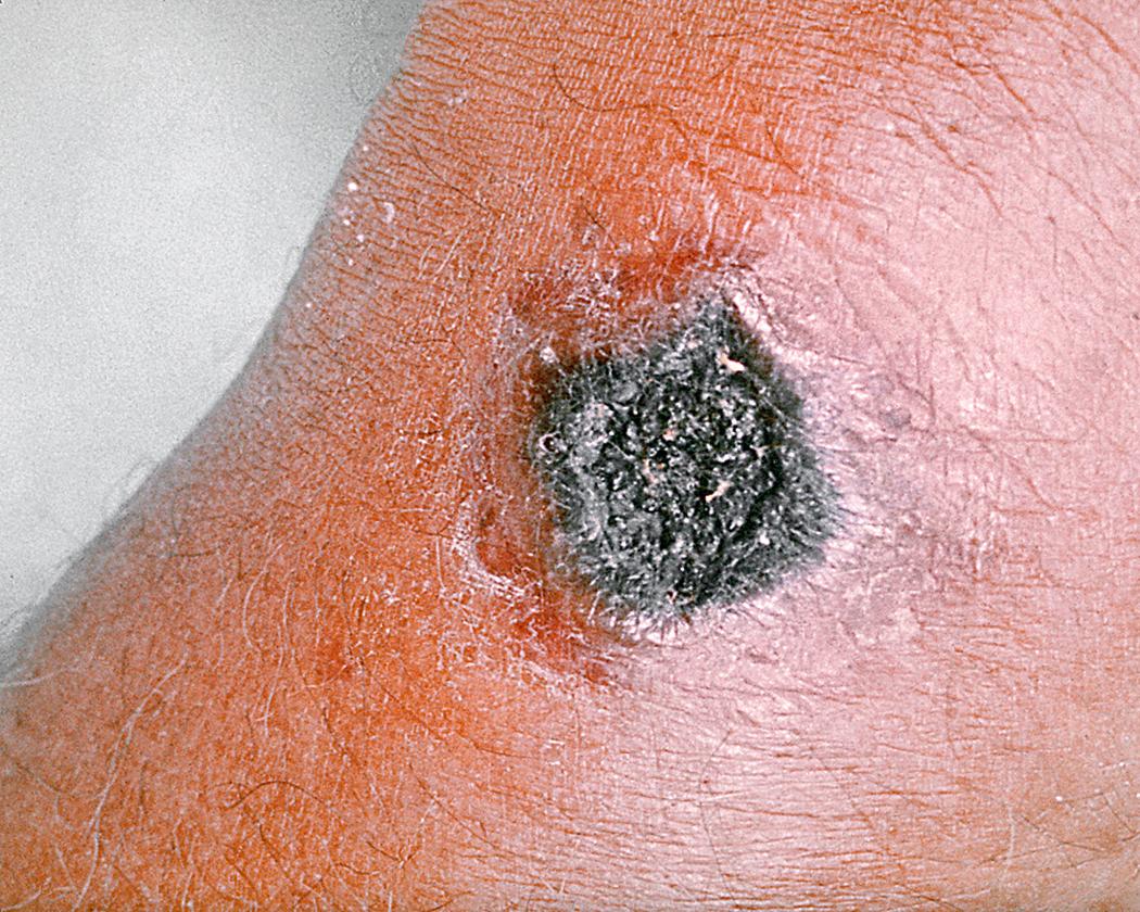 Fig. 3.6, An anthrax skin ulcer has a black central necrosis. The local lesion is painless but the regional lymph nodes may be enlarged and tender.