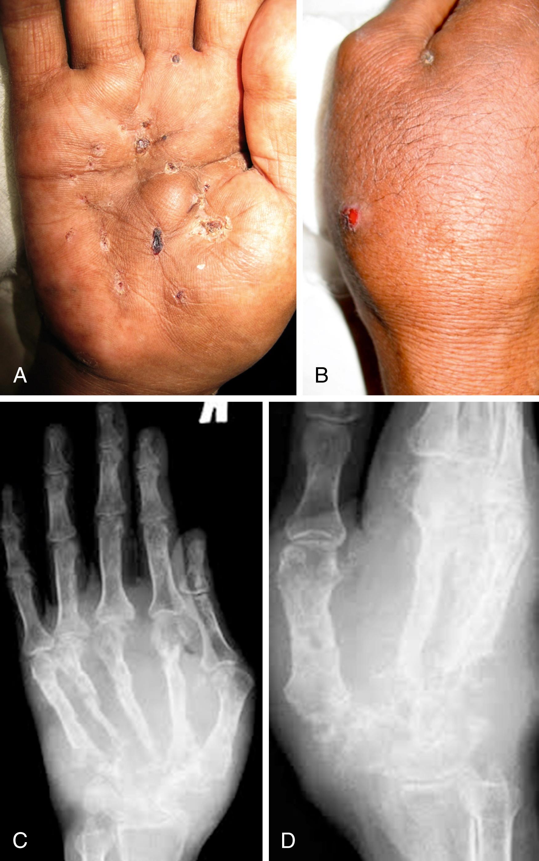 Fig. 3.7, A, This 62-year-old woman from Madura, India, presented with a 7-year history of draining sinuses of the right hand several weeks after a scorpion bite. Multiple courses of antibiotics and other treatments helped transiently. Multiple healed sinuses in various stages can be seen on the indurated palm. B, Infection crosses over to the dorsum of the hand. A culture grew Actinomadura madurae. C and D, As the infection crosses from palmar side to dorsal side of the hand, osteomyelitis of the carpals and metacarpals is evident, characterized by sclerosis and lysis of bone.