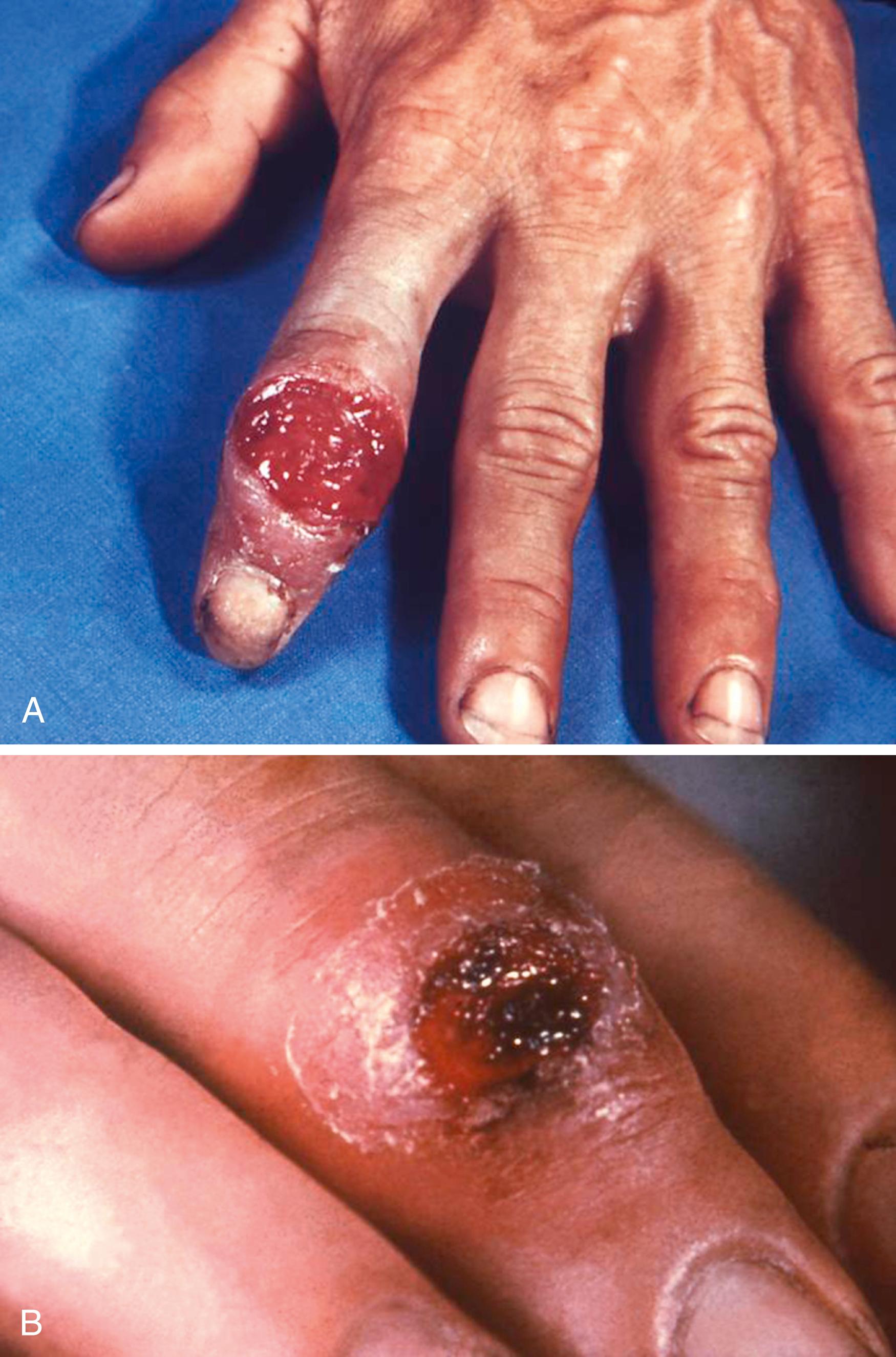 Fig. 3.8, A, Acute syphilitic chancre is red and oozes infected serous fluid. B, As the chancre heals spontaneously or with treatment, peripheral skin peels and the chancre shrinks.