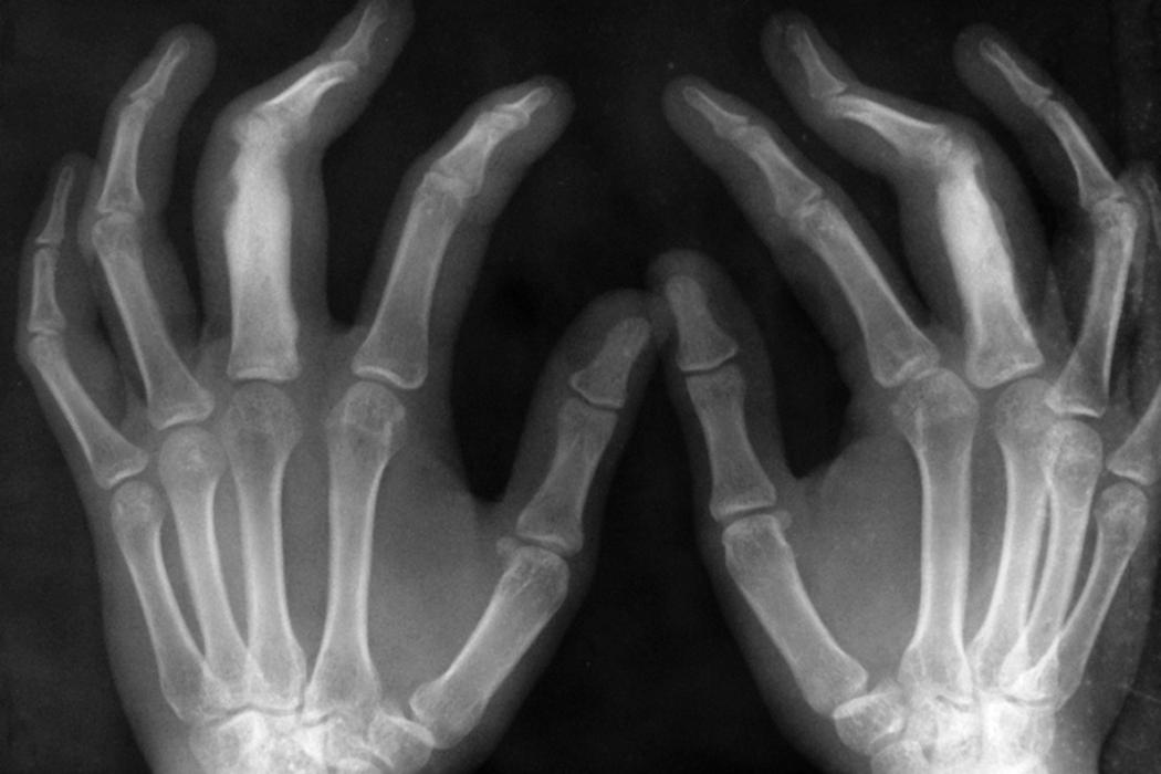Fig. 3.9, Yaws. Dactylitis of proximal phalanges of both middle fingers is characterized by osteoperiostitis. There is periosteal reaction, cortical thickening, sclerosis, and scalloping of proximal phalanges of both middle fingers.