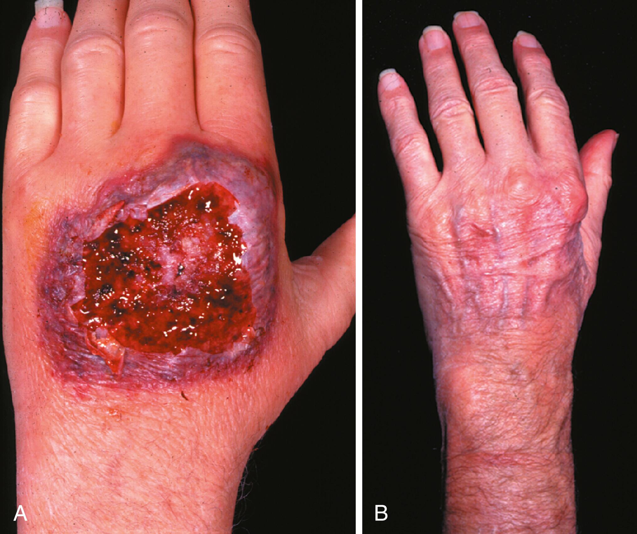 Fig. 3.10, Pyoderma gangrenosum is a mimicker of hand infections, but it is important to identify this condition because its treatment is nonsurgical. A, The ulcer is a centrifugally creeping one surrounded by a rough, serpentine, undermining black-blue rim, which is further encircled by a 5- to 10-mm rim of raised purplish erythema and covered by a thin, translucent, graying epidermis. The central portion undergoes wet gangrenous necrosis, oozes, and impersonates infection. B, With oral cortisone, skin returns to normal because the deep layers of dermis are still intact.