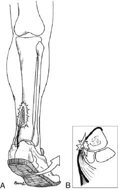 Fig. 23.1, (A) During running, the medial portion of the soleus contracts eccentrically as the foot pronates. Hyperpronating athletes, in particular, are at an increased risk for developing medial tibial stress syndrome (MTSS). (B) The source of pain is at the origin of the flexor digitorum longus (FDL) and soleus fascial bridge on the posteromedial aspect of the tibia.