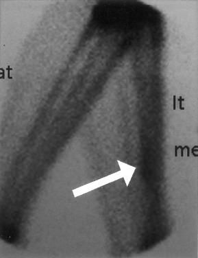Fig. 23.2, Classic bone scan demonstrating the increased linear uptake along the posteromedial aspect of the tibia in the delayed phase indicative of medial tibial stress syndrome (MTSS). The linear uptake is most commonly observed in the distal one third of the leg; however, in this specific case, the location is slightly more proximal.
