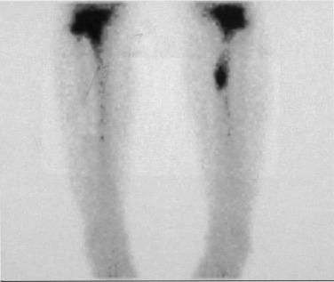 Fig. 23.3, Bilateral bone scan demonstrating normal scintigraphy (left) versus the focal uptake pattern of a typical tibial stress fracture (right) .