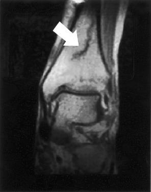 Fig. 23.5, Magnetic resonance imaging portraying the longitudinal signal change in the distal tibia typical of a longitudinal tibial stress fracture.