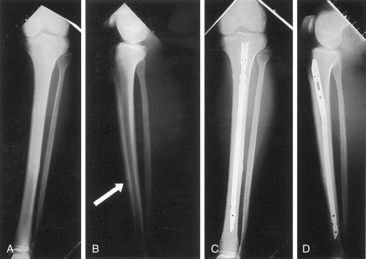 Fig. 23.4, (A and B) Preoperative radiographs of a male runner who presented with a midanterior cortex tibial stress fracture, also referred to as a “dreaded black line” which is visible in the lateral radiograph (B). (C and D) Because of the severity of the fracture, intramedullary nailing was required. As demonstrated in the 2-month postoperative radiographs, the fracture healed completely without the need for bone grafting.