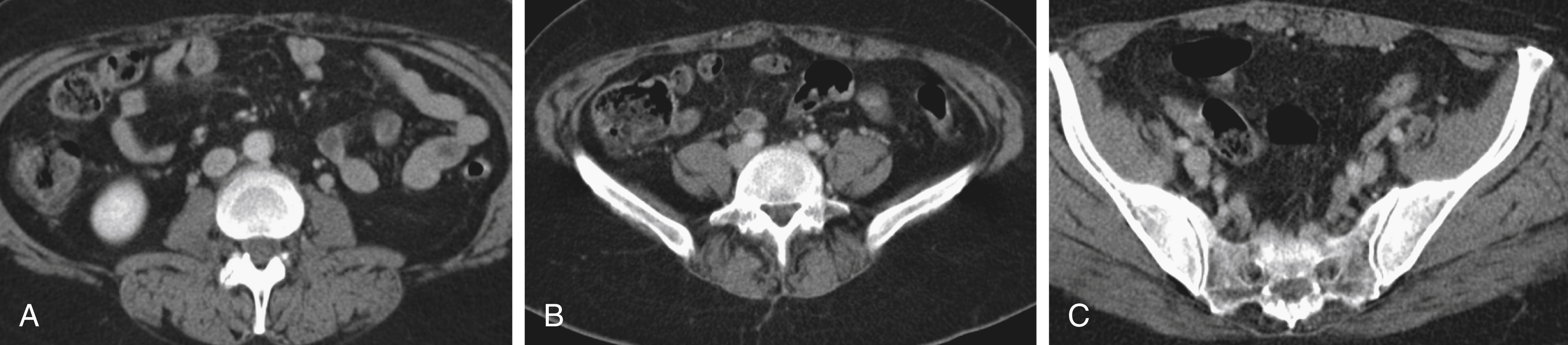 Fig. 69.1, (A) Computed tomography (CT) scan of 46-year-old woman with a 16-year history of chronic leg edema and pain after deep venous thrombosis. Lower part of the abdomen shows a patent and normal-appearing inferior vena cava. (B) CT scan of upper part of pelvis showing normal right common iliac vein and occluded left common iliac vein. (C) CT of lower part of pelvis shows normal right-sided vein and occluded left external iliac vein.