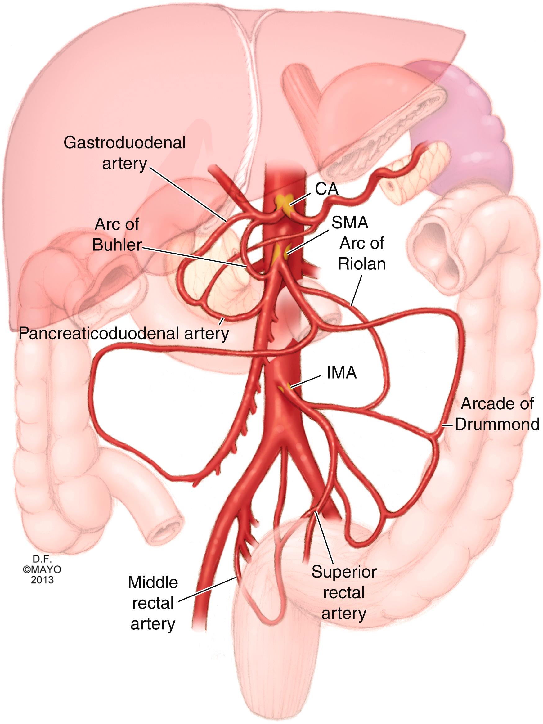 Figure 134.1, Mesenteric artery circulation and common collateral pathways in patients with severe occlusive mesenteric artery disease. Note severe disease at the celiac axis (CA), superior mesenteric artery (SMA), and inferior mesenteric artery (IMA). Common collateral pathways include the arc of Riolan between the left colic artery (IMA) and middle colic artery (SMA). The CA and SMA have collateralization via pancreaticoduodenal arcade (arc of Buhler) and the gastroduodenal arteries.