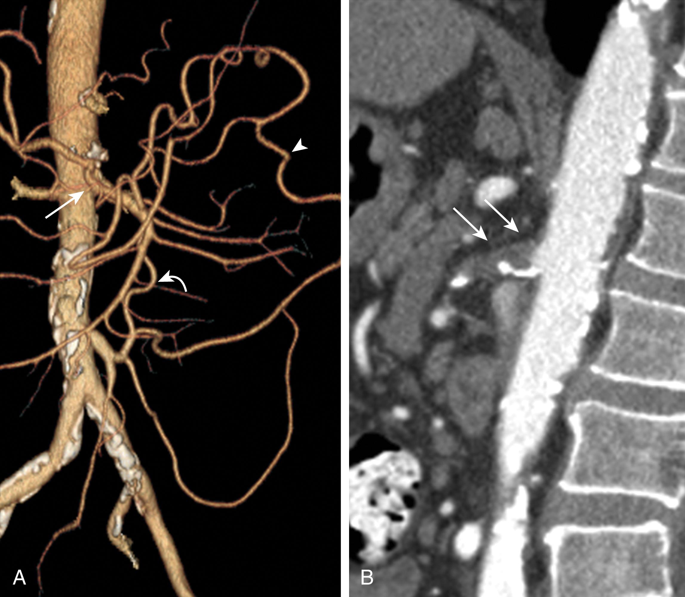 Figure 134.2, Computed tomography angiography with three-dimensional reconstruction in a patient with severe three-vessel mesenteric occlusive disease. Note occlusion of the celiac axis (CA) and superior mesenteric artery (SMA), with collateral flow via a large inferior mesenteric artery (IMA) and meandering artery. ( A ) Collateralization is shown from the IMA to SMA via the arc of Riolan (curved white arrow) and the arcade of Drummond (arrowhead) , and from the SMA to CA via large gastroduodenal artery (straight white arrow) . ( B ) Axial views of the SMA demonstrate occlusion with a small stump (double arrow) .