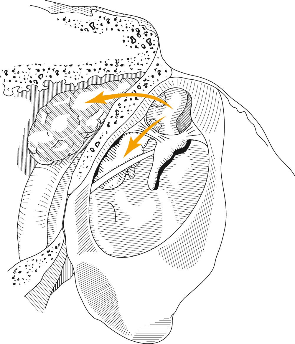 Fig. 140.12, Posterior mesotympanic cholesteatoma.