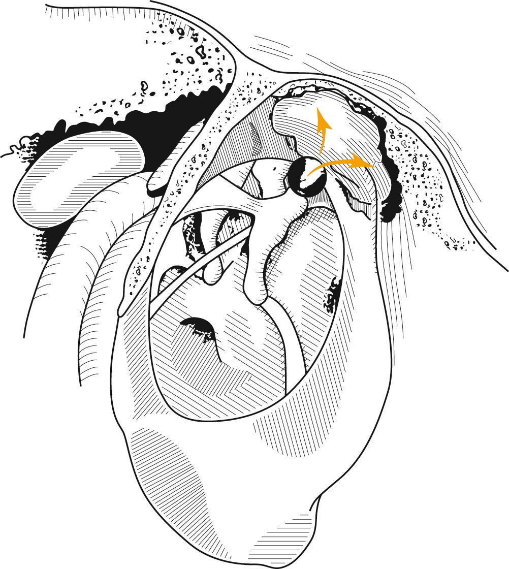 Fig. 140.13, Anterior epitympanic cholesteatoma. Invagination of epitympanum anterior to malleus head and neck creates a cholesteatoma sac that threatens horizontal facial nerve and geniculate ganglion. Forward extension into supratubal recess is common.