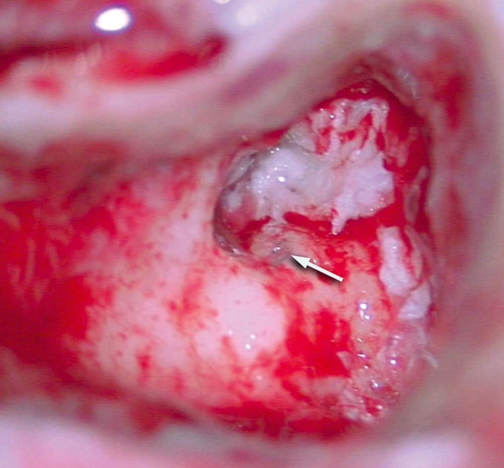 Fig. 140.4, Intraoperative photo showing a horizontal canal fistula (arrow) from a cholesteatoma.