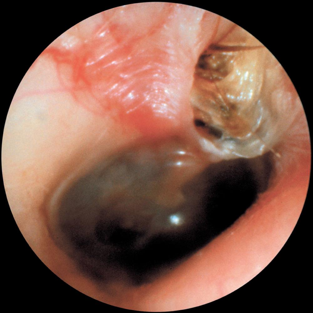 Fig. 140.5, Primary acquired cholesteatoma in the region of the pars flaccida with scutum erosion.