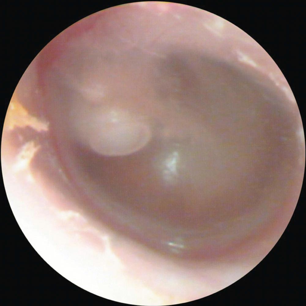 Fig. 140.7, Cholesteatoma behind intact tympanic membrane. This is the typical appearance of a congenital cholesteatoma.