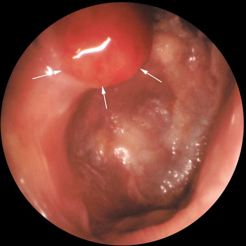 Fig. 140.8, One of the hallmarks of a cholesteatoma is granulation tissue (arrows) near the eroded bone of the ear canal.