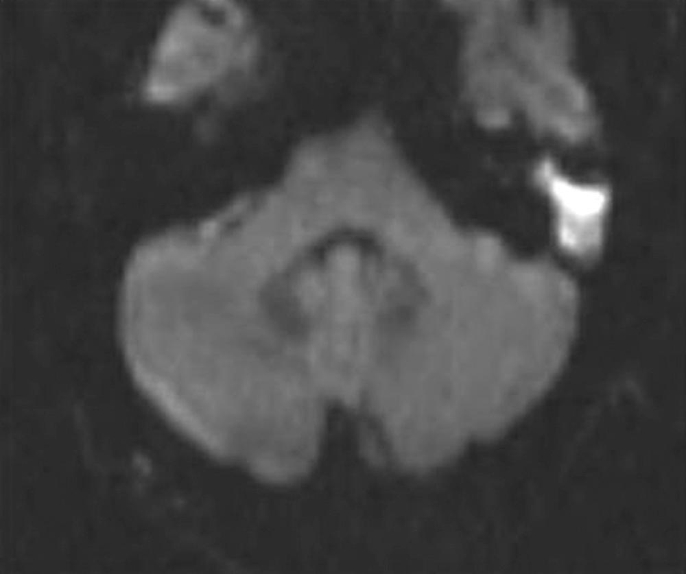 Fig. 140.9, A non–echo planar diffusion-weighted magnetic resonance imaging scan of a patient with a cholesteatoma (bright area) .