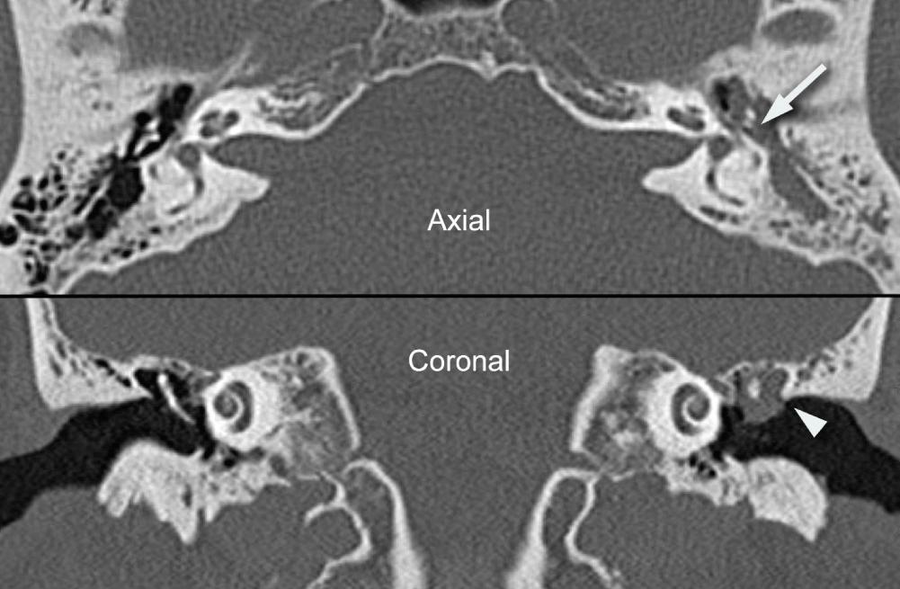 Fig. 140.10, An axial and coronal computed tomography scan of a patient with a left attic cholesteatoma. The incus (arrow) and the scutum has been eroded (arrowhead) .