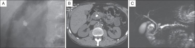 FIG 55.1, Example of planning endoscopic therapy in a patient with chronic pancreatitis and severe pain. The plain film (A) shows a dense calcification, which is even more clearly visible on an unenhanced computed tomography scan (B) , whereas the dynamic magnetic resonance cholangiopancreatography after secretin injection shows an impacted stone at the level of the genu of the pancreas, with upstream dilation, and the main pancreatic duct in the head has a normal size (C) . In this patient, extracorporeal shock wave lithotripsy was performed before endoscopic intervention.