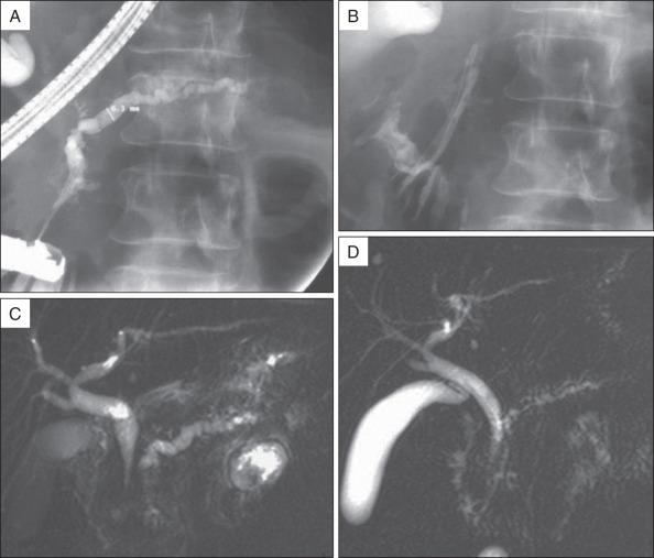 FIG 55.2, Patient with a residual prepapillary stricture after stone fragments extraction (A) , treated by placement of two 8.5-Fr stents side-by-side (B) . A comparison of secretin-stimulated magnetic resonance cholangiopancreatography performed before (C) and after (D) drainage shows a decrease in main pancreatic duct diameter and the earlier duodenal filling by pancreatic secretions.