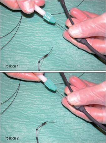 FIG 55.3, The use of a minitome (Cook Endoscopy, Winston-Salem, NC) with a 0.018 J-tip Terumo guidewire manipulated by the assistant with a torque device offers the best performance for cannulating difficult and tortuous strictures under fluoroscopic guidance.