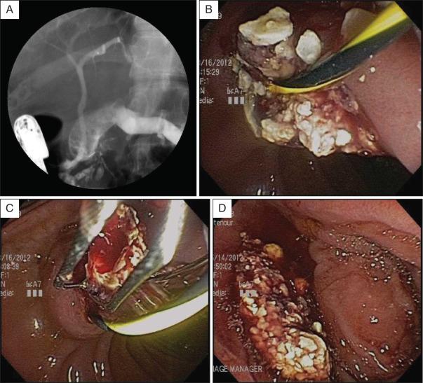 FIG 55.5, Extracorporeal shock wave lithotripsy (ESWL) followed by ERCP. A, Pancreatogram after ESWL shows large, amorphous filling defect. Note that there is no focal stone and dispersion of prior stone consistent with successful ESWL. B, Endoscopic view of guidewire placement into main pancreatic duct (MPD) with stone fragments passing out of prior pancreatic sphincterotomy. C, Endoscopic view of basket passed alongside guidewire placed into MPD with removal of stone fragments. D, Endoscopic view of stone fragments in the duodenum after complete endoscopic clearance.