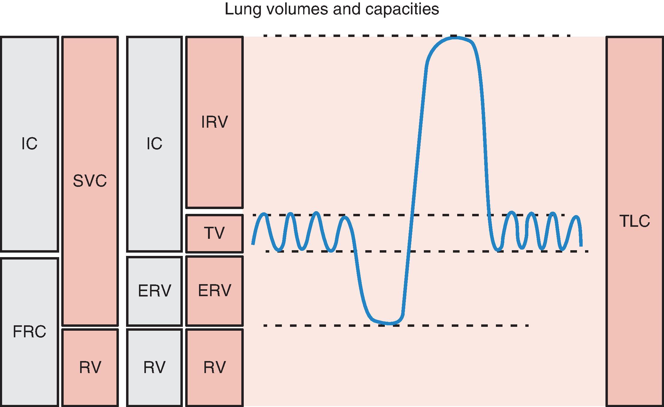 Fig. 27.2, Complete pulmonary function testing will provide data on lung volumes and capacities to differentiate obstructive from restrictive diseases. ERV, Expiratory reserve volume; FRC, functional residual capacity; IC, inspiratory capacity; IRV, inspiratory reserve volume; RV, residual volume; SVC, slow vital capacity; TLC, total lung capacity; TV, tidal volume. (Reprinted from Patterson AG, Cooper JD, Deslauriers J, et al., eds. Pearson’s Thoracic and Esophageal Surgery. 3rd ed. Philadelphia: Elsevier; 2008. p. 1168, with permission.)