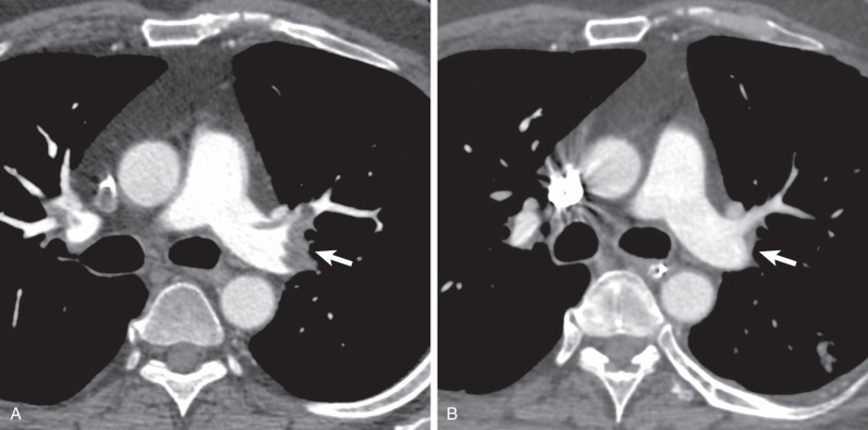 Fig. 51.1, Natural history of acute pulmonary embolism: complete resolution. (A) Axial CT scan shows acute pulmonary emboli in the left main and left upper lobe anterior segmental pulmonary arteries (arrow). Additional right upper lobe pulmonary artery embolism is also noted. (B) Axial CT scan obtained 2 months later, after adequate anticoagulant treatment, shows complete resolution of the endoluminal clot (arrow).