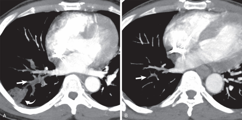 Fig. 51.2, Natural history of acute pulmonary embolism: evolution to chronic pulmonary embolism. (A) Axial CT scan shows acute right lower lobe pulmonary emboli (straight arrow), with a pulmonary infarct (curved arrow). (B) CT image obtained 1 year later, after adequate anticoagulation, shows chronic emboli in the same distribution, with a marked decrease in diameter of the right lower lobe pulmonary arteries (arrow).