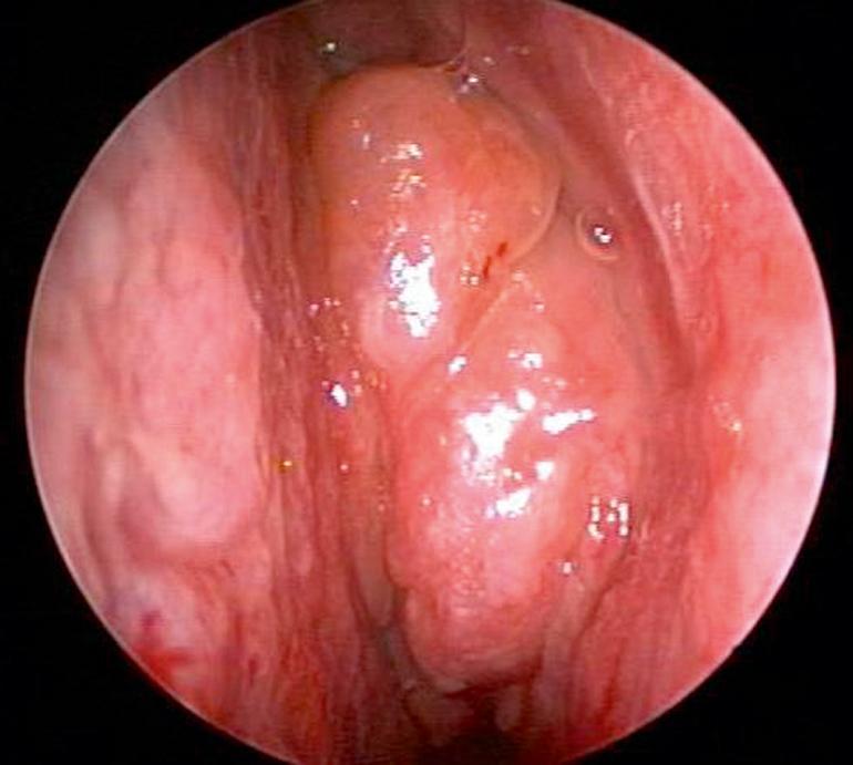 Fig. 27.1, Nasal endoscopy, left nasal cavity. Nasal polyps arising from middle meatus.