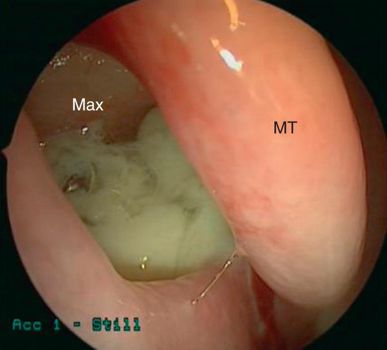 Fig. 27.2, Nasal endoscopy, right nasal cavity showing purulent secretions pooling in right maxillary sinus. MT = middle turbinate, Max = maxillary sinus.