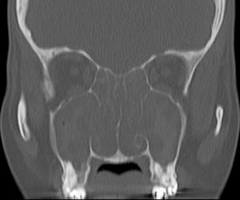 Fig. 27.3, Coronal noncontrast CT scan showing opacification of all paranasal sinuses.