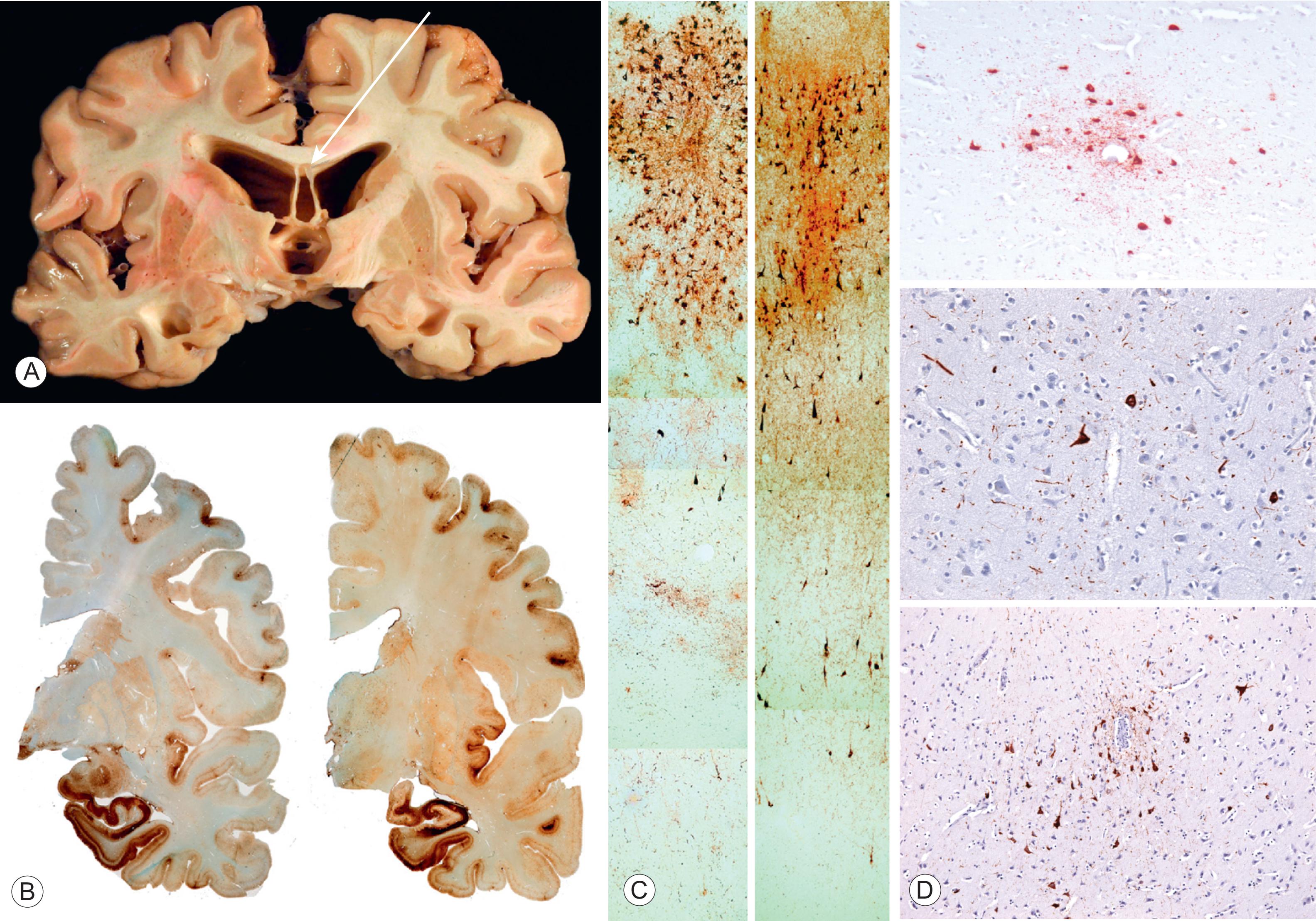 Fig. 15.1, Pathology of chronic traumatic encephalopathy. Gross pathology (A) shows atrophy of cerebral hemispheres, medial temporal lobes, ventricular dilatation, and a fenestrated cavum septum pellucidum (arrow) . Whole-mount 50-mm-thick coronal sections show dense deposition of tau protein in medial temporal lobe structures, with less dense deposition elsewhere in the cortex in two cases (B) . Microscopic views of the same two cases showing prominent perivascular collections of neurofibrillary and astrocytic tangles evident in the superficial cortical layers with lesser involvement of the deep laminae (C) . Note that this pathology is different from that of Alzheimer’s disease (see Chapter 4 ). Perivascular deposition of tau pathology is pathognomonic for chronic traumatic encephalopathy (D) .