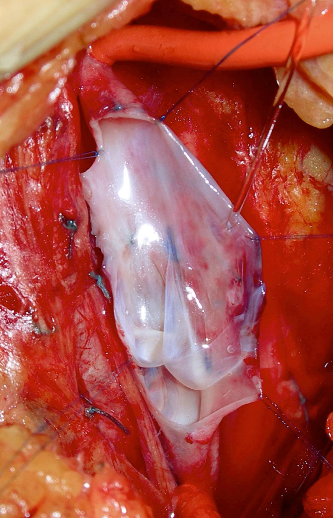 Figure 159.1, Floppy and asymmetrical venous valve leaflets seen after vein opened in the method of Kistner to reveal the valve cusps.