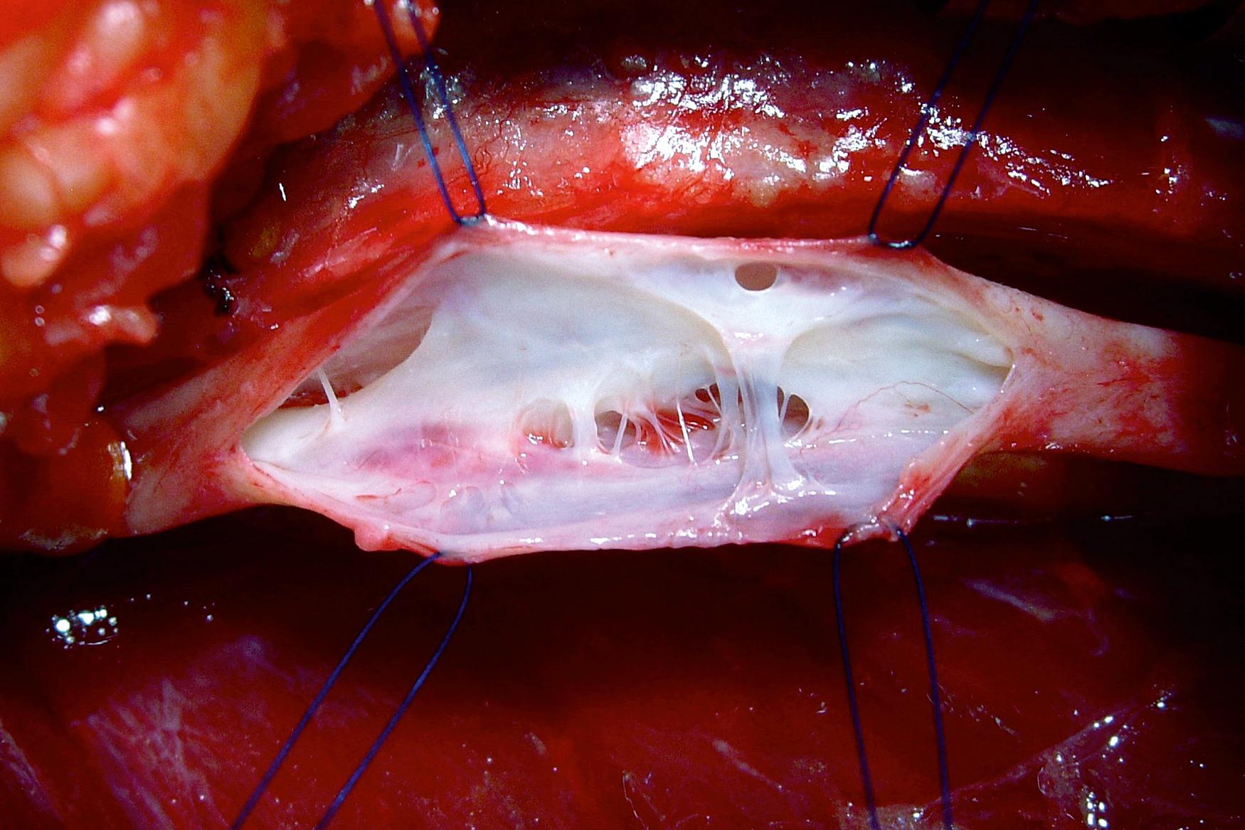 Figure 159.2, Valve destruction resulting from deep vein thrombosis with scarring within the vein, bridges of scar wall to wall (synechia), but overall patent vein due to recanalization.