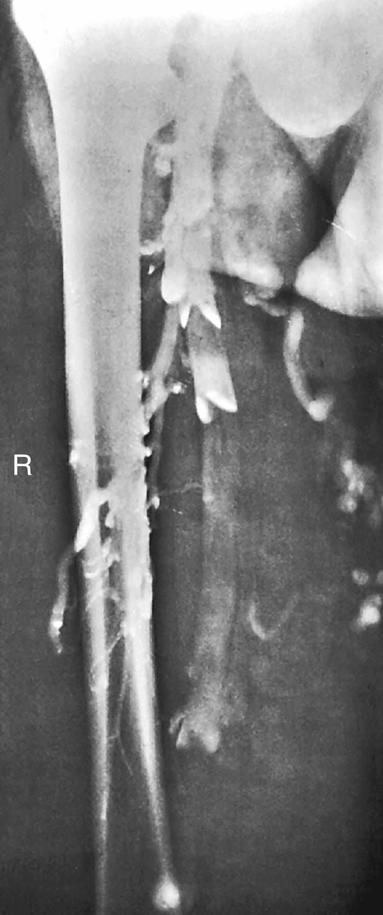 Figure 159.3, Descending venogram demonstrating the presence of valves with architecturally preserved cusps available for in situ repair.