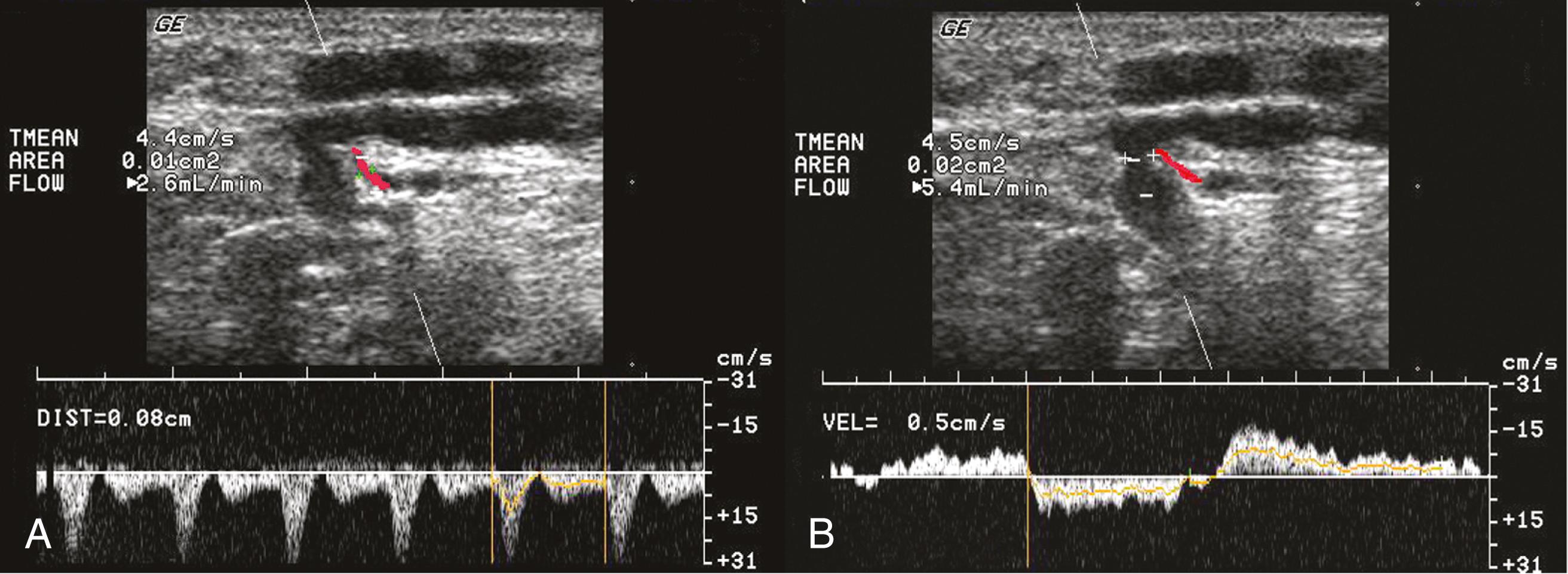 Figure 158.1, ( A ) A small perforating artery is located next to the perforating vein at the fascial level. Pulsed-wave Doppler confirms arterial flow. ( B ) Doppler signal from the incompetent perforating vein indicates bidirectional flow.