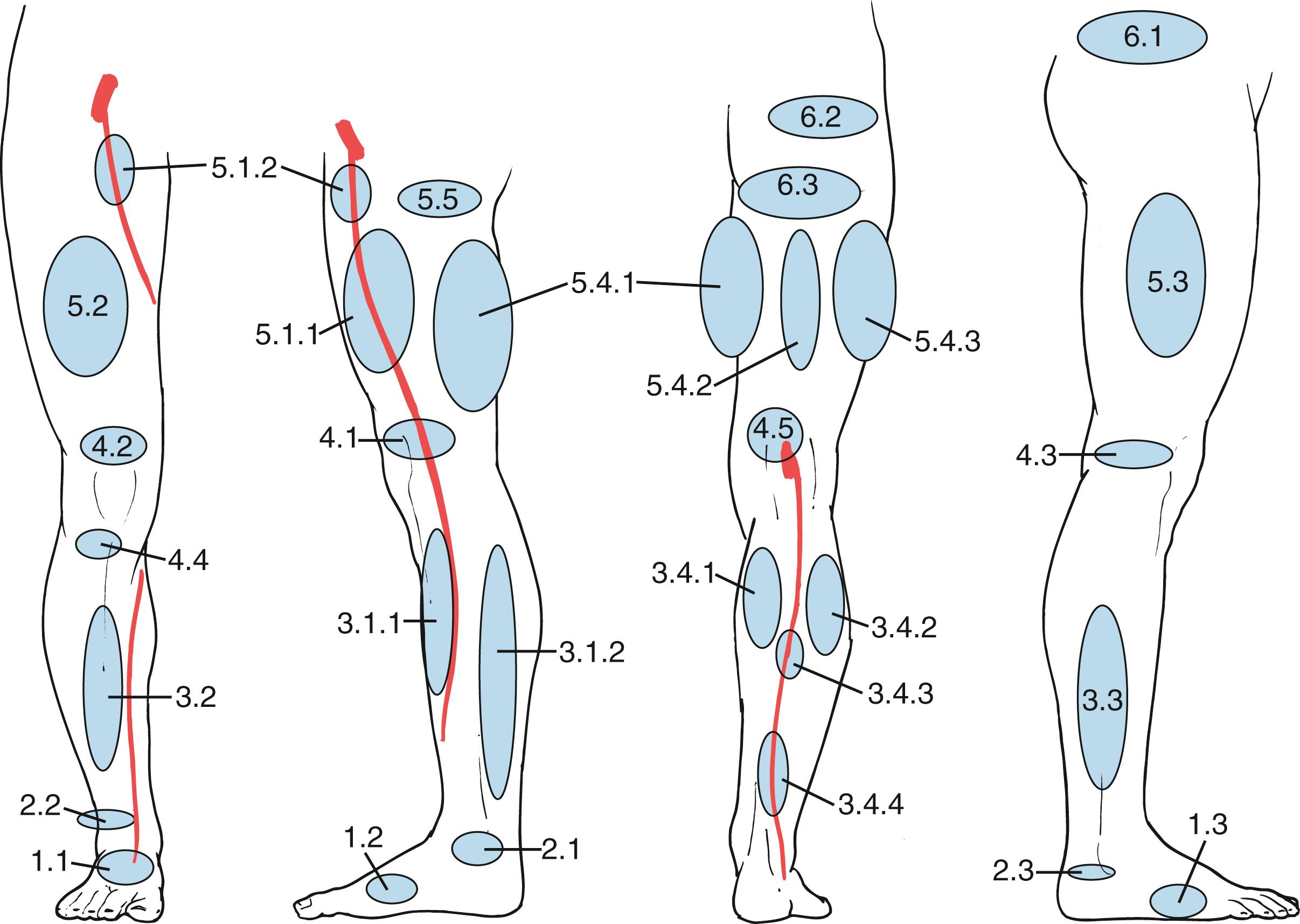 Figure 158.2, Schematic representation of the topography of the main groups of perforating veins (PVs). Foot PVs: 1.1, dorsal foot PV; 1.2, medial foot PV; 1.3, lateral foot PV. Ankle PVs: 2.1, medial ankle PV; 2.2, anterior ankle PV; 2.3, lateral ankle PV. Leg PVs: 3.1.1, paratibial PV; 3.1.2, posterior tibial PV; 3.2, anterior leg PV; 3.3, lateral leg PV; 3.4.1, medial gastrocnemius PV; 3.4.2, lateral gastrocnemius PV; 3.4.3, intergemellar PV; 3.4.4, para-achillean PV. Knee PVs: 4.1, medial knee PV; 4.2, suprapatellar PV; 4.3, lateral knee PV; 4.4, infrapatellar PV; 4.5, popliteal fossa PV. Thigh PVs: 5.1.1, PV of the femoral canal; 5.1.2, inguinal PV; 5.2, anterior thigh PV; 5.3, lateral thigh PV; 5.4.1, posteromedial thigh PV; 5.4.2, sciatic PV; 5.4.3, posterolateral thigh PV; 5.5, pudendal PV. Gluteal PVs: 6.1, superior gluteal PV; 6.2, midgluteal PV; 6.3, lower gluteal PV.