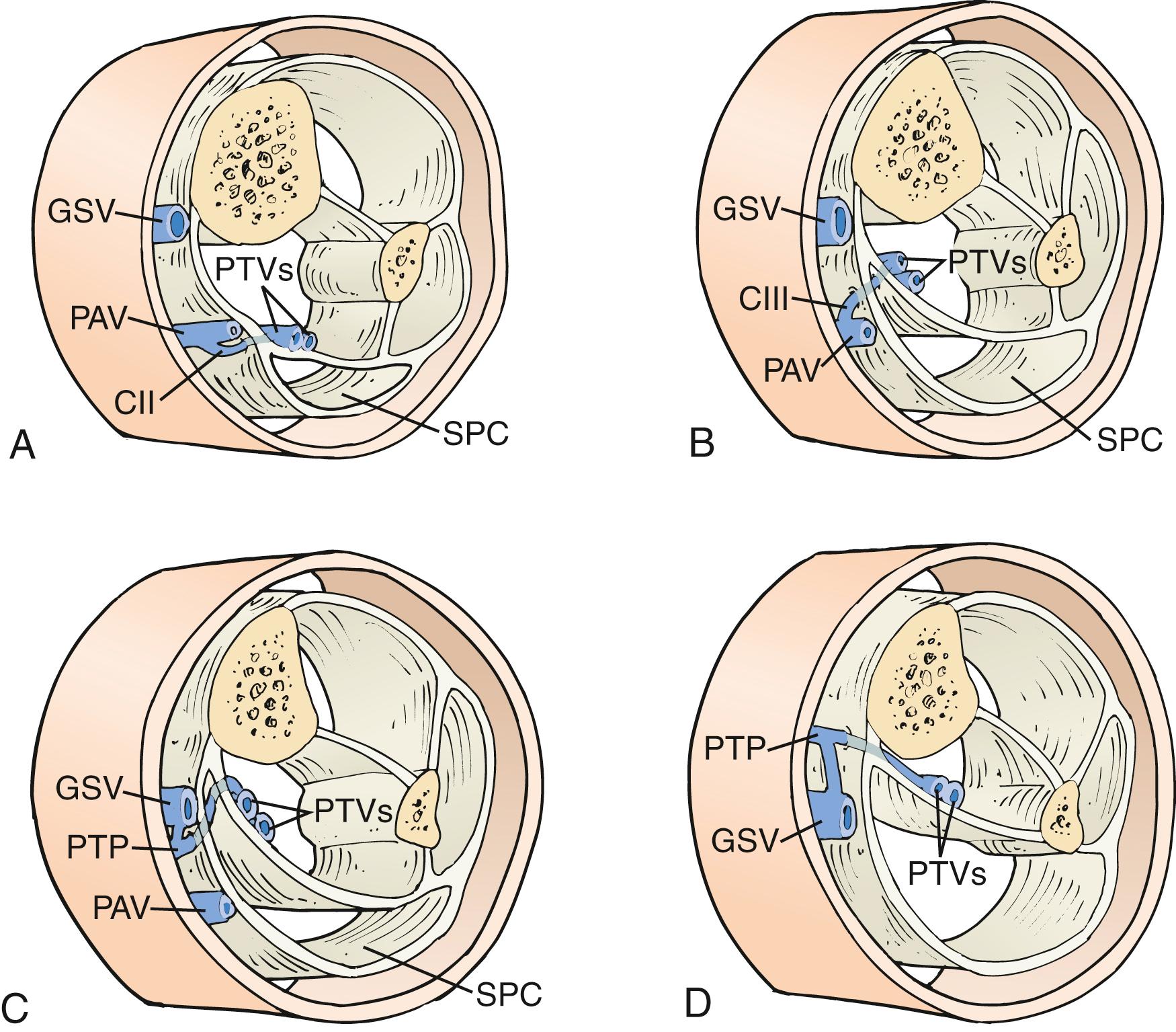 Figure 158.3, Compartments and medial veins of the leg. Cross sections are shown at the level of Cockett II (posterior tibial perforator) ( A ), Cockett III ( B ), “24 cm” ( C ), more proximal paratibial ( D ) perforating veins. CII, Cockett II; CIII, Cockett III; GSV, great saphenous vein; PAV, posterior arch vein; PTP, paratibial perforator; PTVs, posterior tibial veins; SPC, superficial posterior compartment.