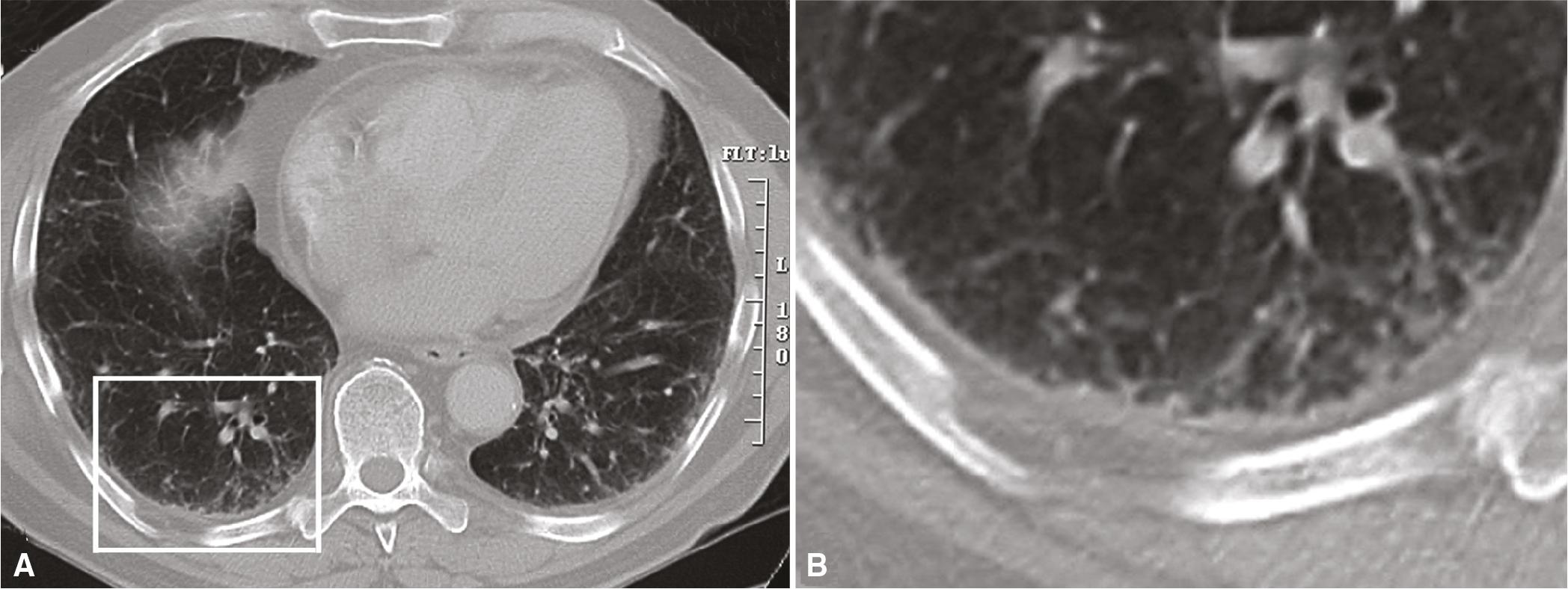 Figure 8.1, Usual interstitial pneumonia (UIP). (A) This computed tomography scan shows the early subtle findings in UIP, with delicate pleura-based reticular opacities in the lower lung zones and a few small honeycomb cysts. (B) Higher magnification of the boxed area from part A.