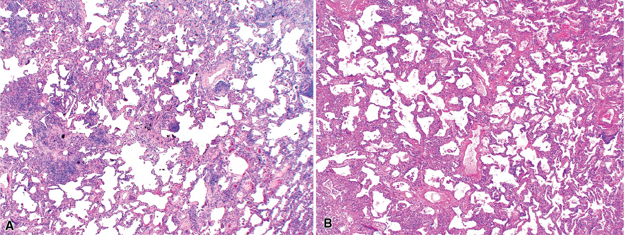 Figure 8.12, Nonspecific interstitial pneumonia (NSIP). The histopathology of NSIP is temporally uniform, in contrast with the temporal heterogeneity of the usual interstitial pneumonia pattern. Two examples are shown here: (A) Small lymphoid aggregates can be appreciated at scanning magnification; (B) the process is uniform and may be associated with interstitial widening and some interstitial fibrosis.