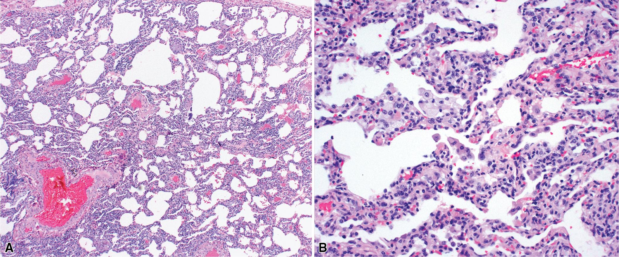 Figure 8.13, Nonspecific interstitial pneumonia (NSIP). (A) The chronic inflammatory infiltration in NSIP is diffuse and relatively uniform, mainly involving the alveolar walls. (B) Lymphocytes and plasma cells are the dominant cells.